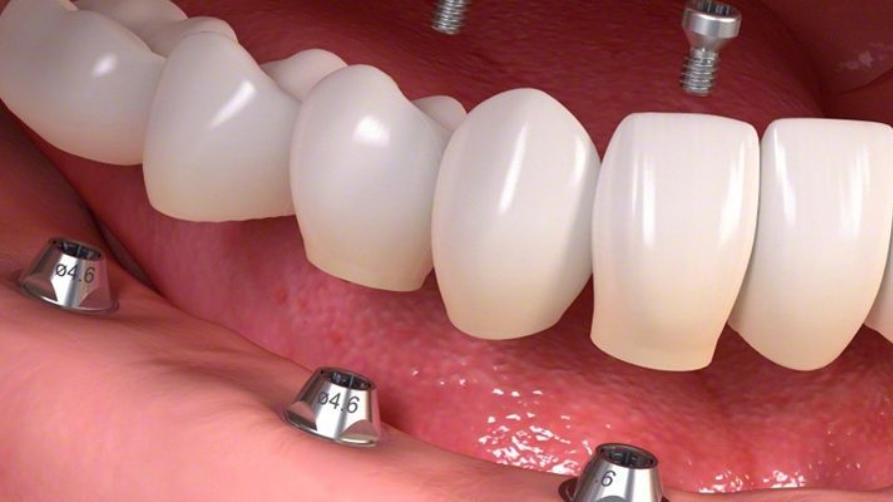 ¿Qué país es mejor para los implantes dentales?