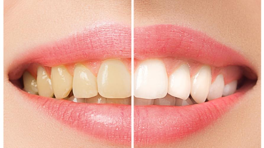 Как происходит отбеливание зубов?