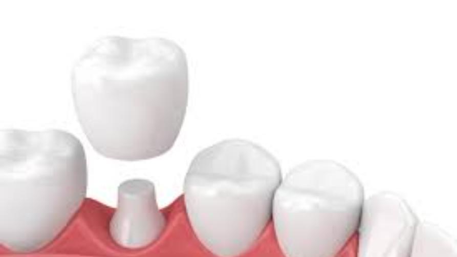 Co znamená zubní korunka? Průměrné ceny zubních korunek v Turecku
