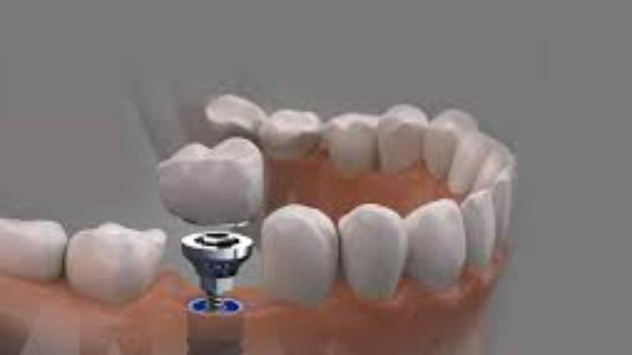 Bei wem wird die Zahnimplantatbehandlung angewendet?