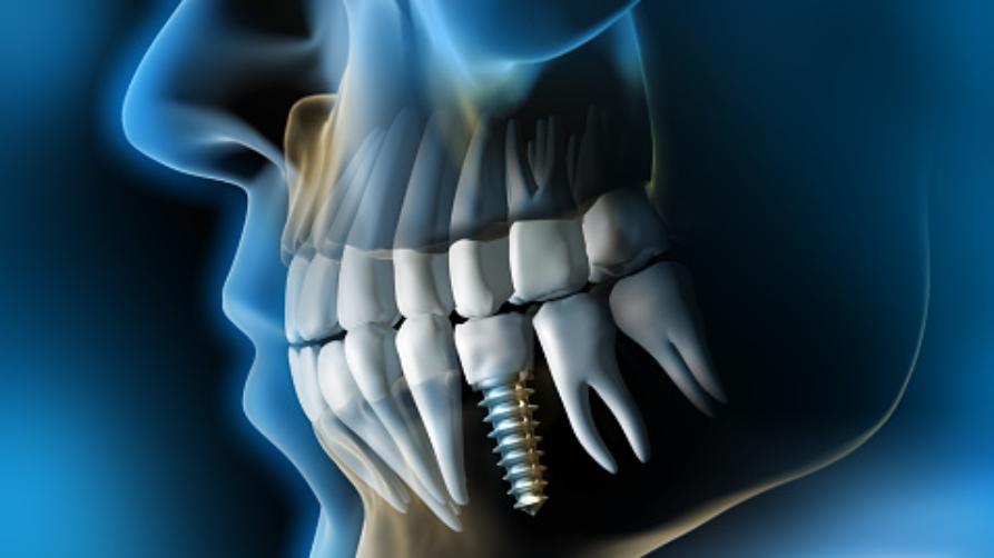 Имплантация зубов в тот же день в Турции