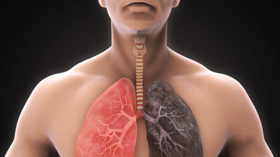 COPD څه شی دی؟ ایا د COPD لپاره درملنه شتون لري؟ په ترکیه کې د COPD درملنه