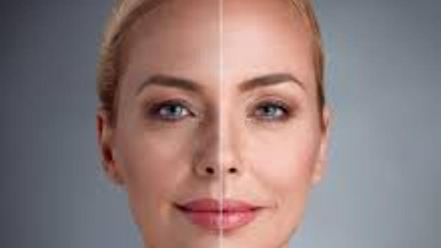 Какво представлява хирургията за повдигане на лицето?
