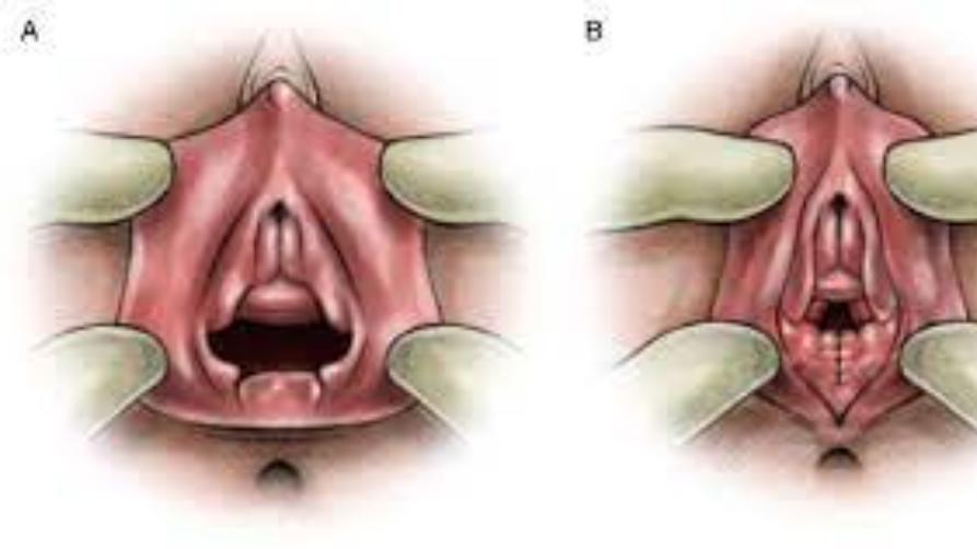Hogyan történik a perineoplasztika?