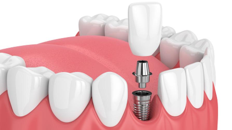 Wie ist der Zahnimplantatprozess?