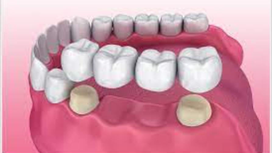 Léčba zubního můstku v Turecku