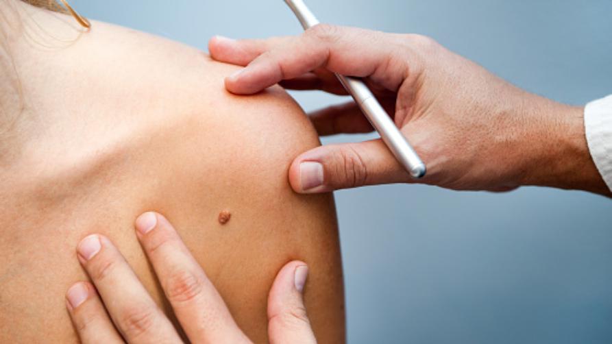 Co je rakovina kůže?