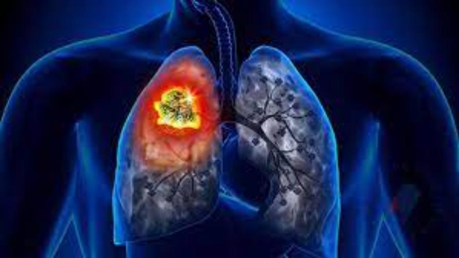 Lungenkrebs-Überlebensrate