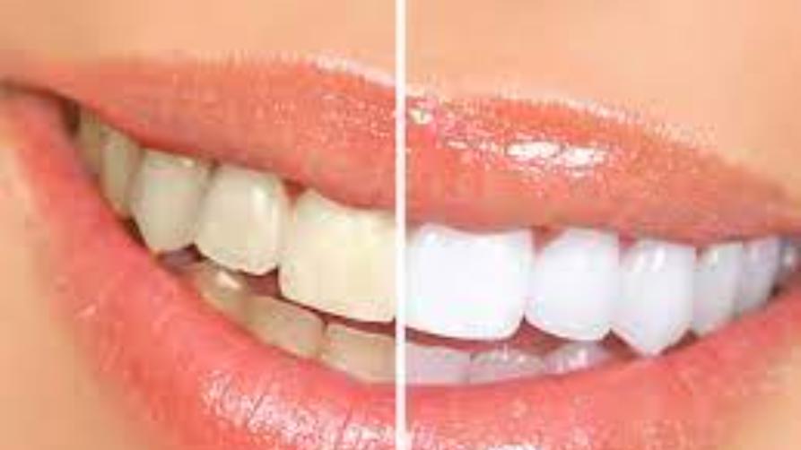 Что такое отбеливание зубов и методы отбеливания зубов?