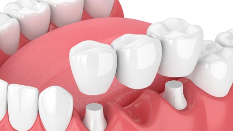 Procedimiento de puente dental en Turquía