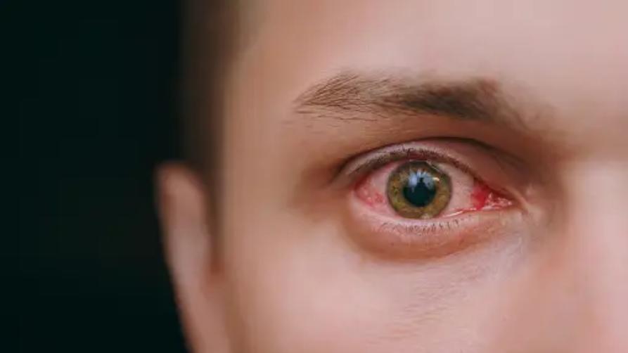 Keratopigmentační ošetření v Turecku: Postup při změně barvy očí
