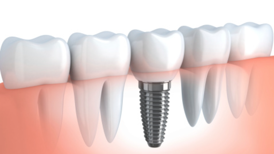 Co je to zubní implantát?