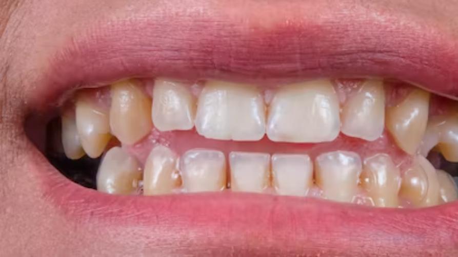 Implants dental mirah Turki