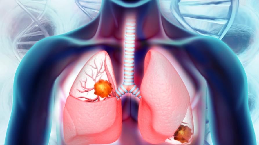 Co je rakovina plic?