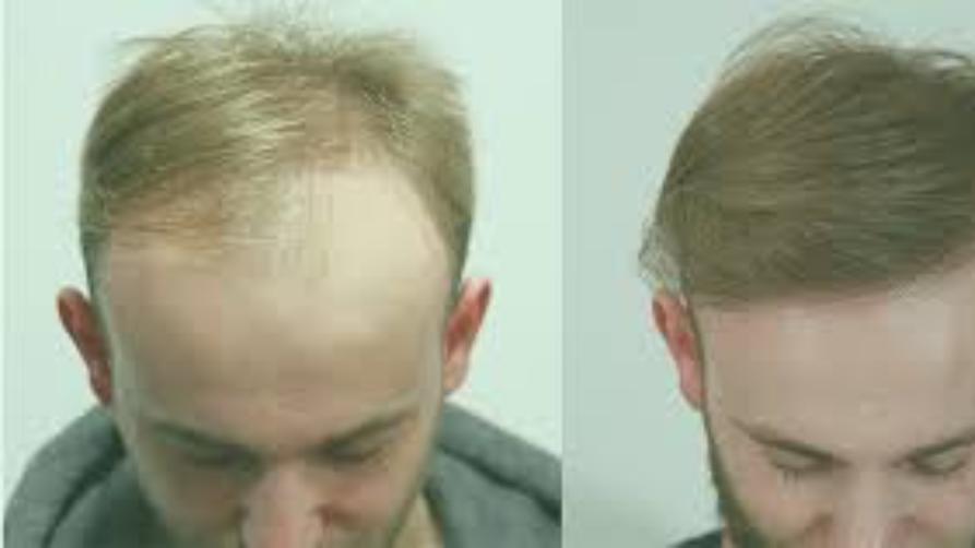 Hvordan gjøre hårtransplantasjon? Trenger å vite