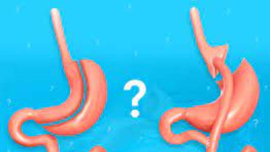 Často kladené otázky o operaci bypassu žaludku