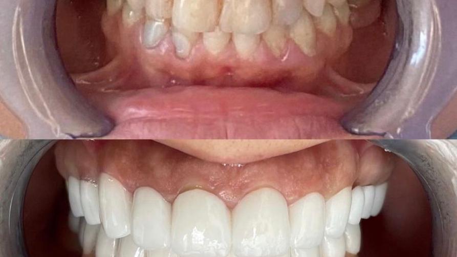 Stambulas zobu kronis: risinājums, kas nodrošina izcilu estētiku un funkcionalitāti