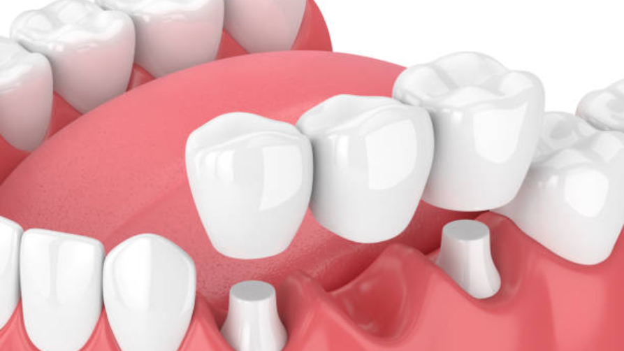 Co je to zubní můstek?