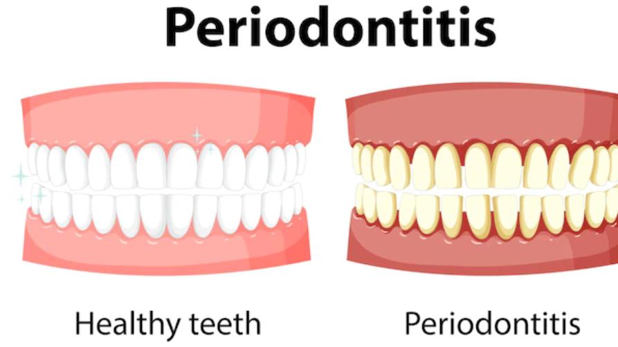Cik ilgi kalpo zobu kronis?